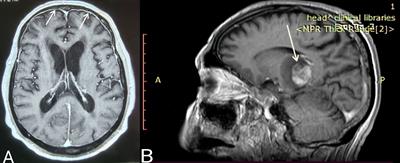 Bing-Neel Syndrome: Real-Life Experience in Personalized Diagnostic Approach and Treatment